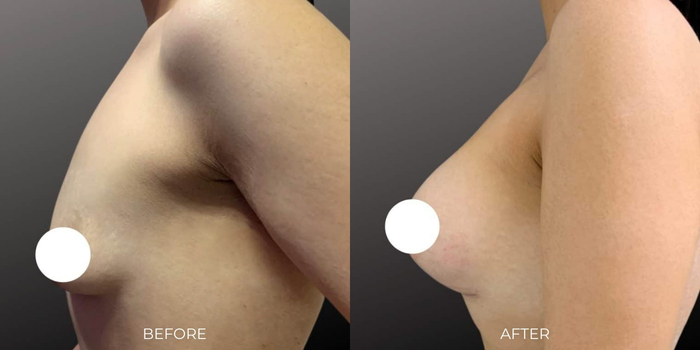 Breast Augmentation Perth by Dr Glenn Murray