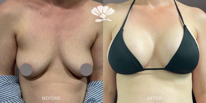 Breast Augmentation Perth by Dr Glenn Murray