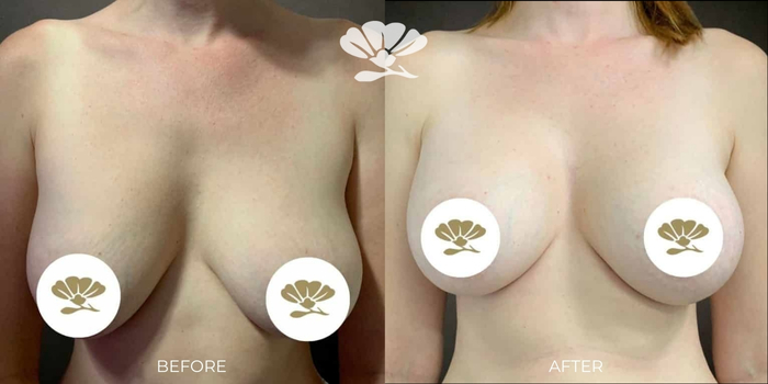 Breast Augmentation Perth by Dr Glenn Murray