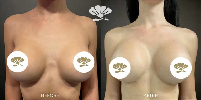 Breast Implant Surgery Perth WA