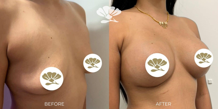 Breast Augmentation Perth by Dr Glenn Murray