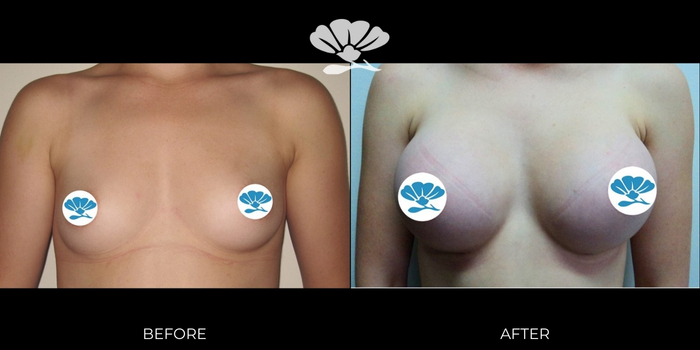 Breast Augmentation Perth by Dr Glenn Murray