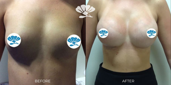 Breast Implants Perth by Dr Glenn Murray