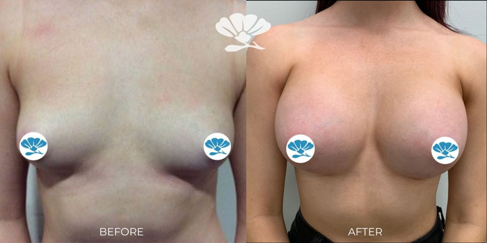 Breast Augmentation Perth by Dr Glenn Murray