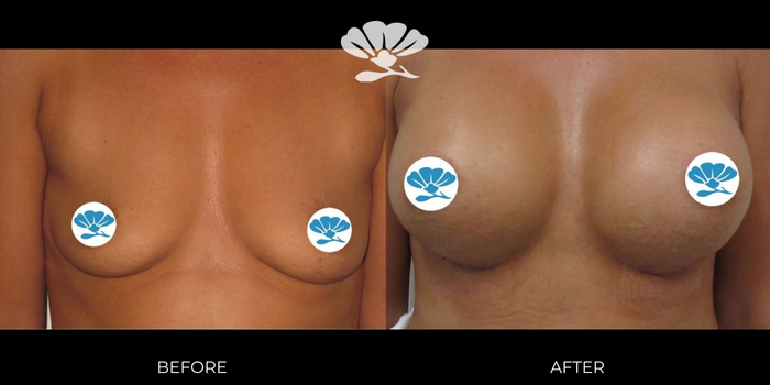 Breast Augmentation Perth by Dr Glenn Murray