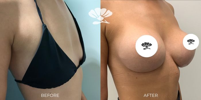 Breast implant surgery near me