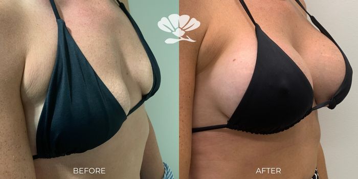 breast augmentation surgery near me