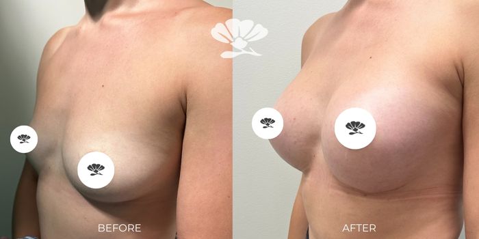 breast enlargement perth befoer after