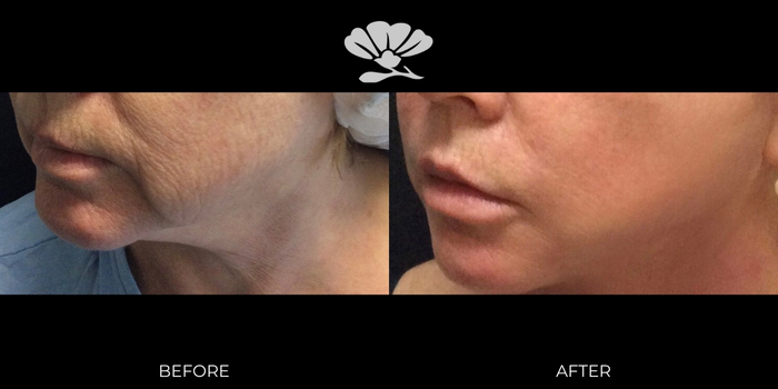 Before and After Erbium Laser facial skin resurfacing Perth