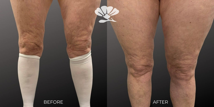 Fat transfer perth knees thighs