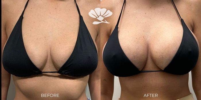 breast implants perth