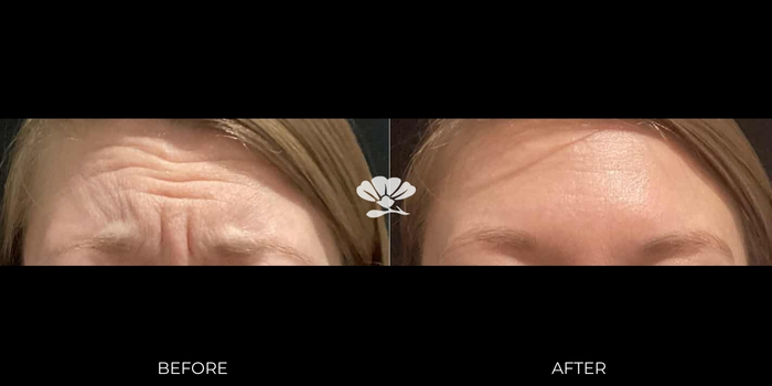 fore head botox injections before and after