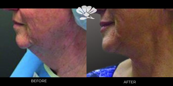 Before and After Face lift fat transfer by Dr Glenn Murray, Perth