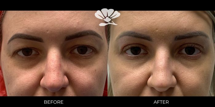 upper blepharoplasty Perth hooded eyes