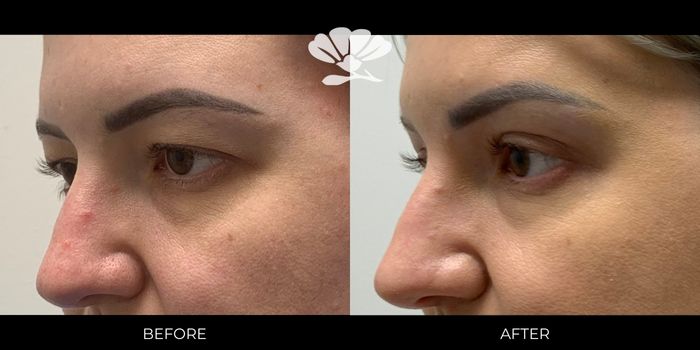 saggy eyelid surgery perth