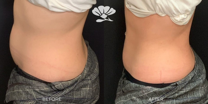 Coolsculpting Fat Freezing Stomach Perth Before and After Results