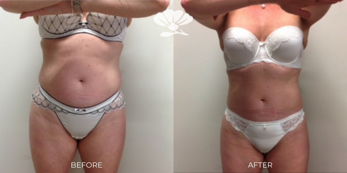 Coolsculpting Fat Freezing Tummy Perth Before and After Results