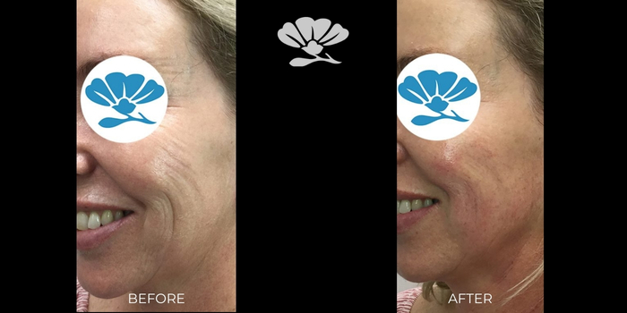 Dermal Filler skin boosters Perth