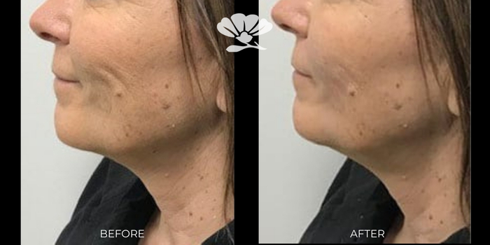 Skin boosters Perth clinic