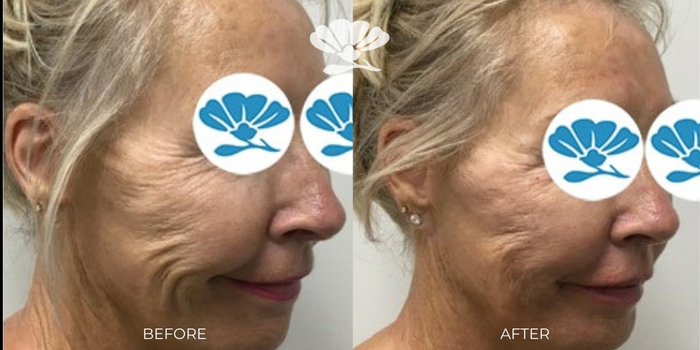 Skin boosters face smile lines Perth