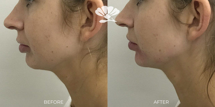 Chin and jawline filler Perth - before and after photo