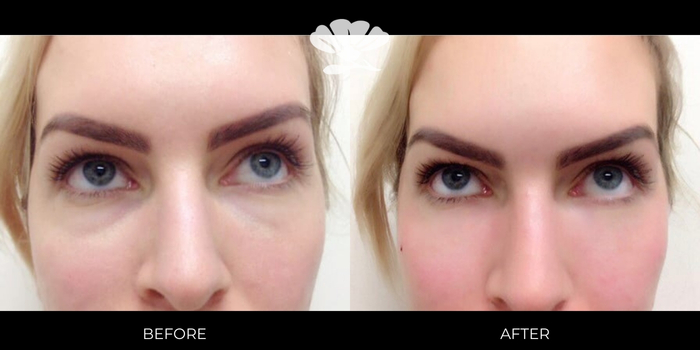 Under eye Tear trough filler Perth