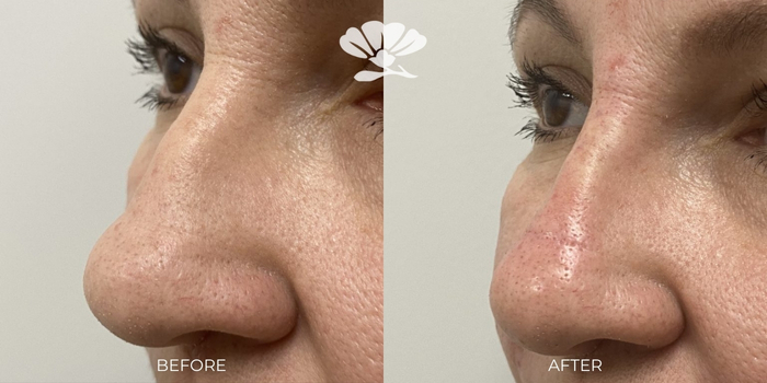 Liquid Rhinoplasty Filler by Dr Glenn Murray Perth