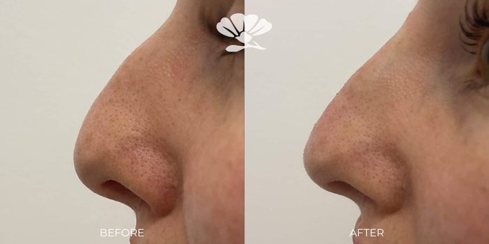 Liquid Rhinoplasty Filler by Dr Glenn Murray Perth