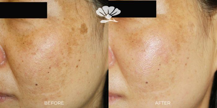 Best Pigmentation laser treatment Perth