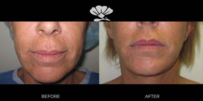 Before and After Face lift fat transfer by Dr Glenn Murray, Perth