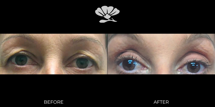 Upper Eyelid Reduction Surgery (Upper Blepharoplasty) Before and After