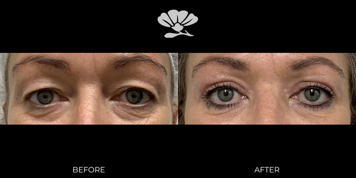 Blepharoplasty eye bags before and after Perth surgeon