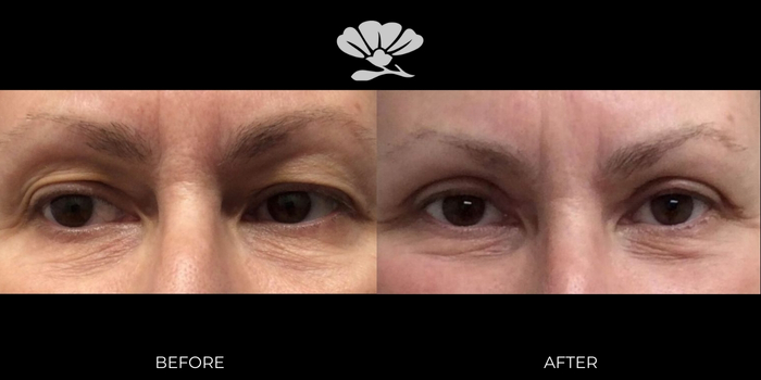 Upper Eyelid Reduction Surgery (Upper Blepharoplasty) by Dr Glenn Murray Perth