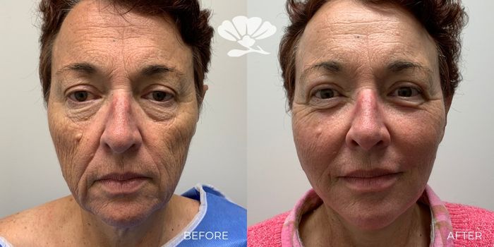 Mini Face Lift Neck Lift Perth Surgery Best Near Me