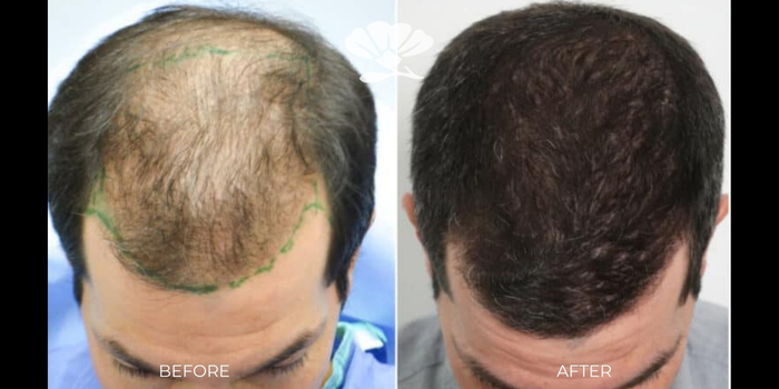 Hair Transplant Perth New Hair Clinic Before and After