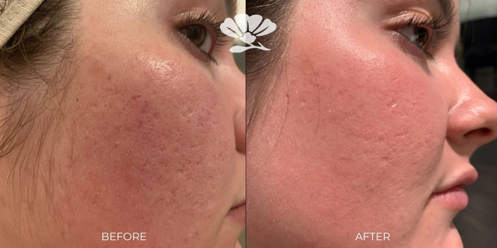 C02 Dot Laser Fractional Before and After Perth