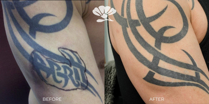 Laser tattoo removal perth before and after