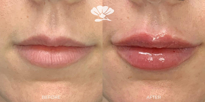 Lip Filler 0.5 ml Perth