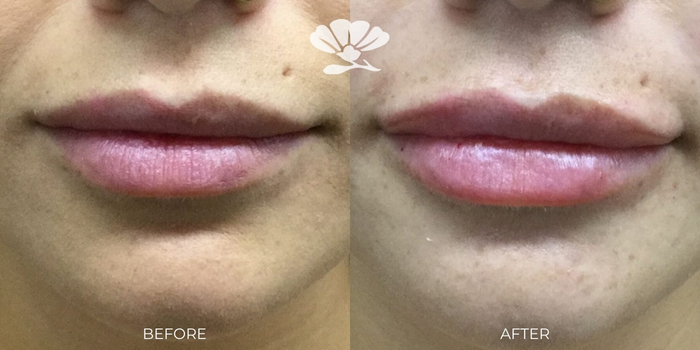 Lip filler best injector Perth