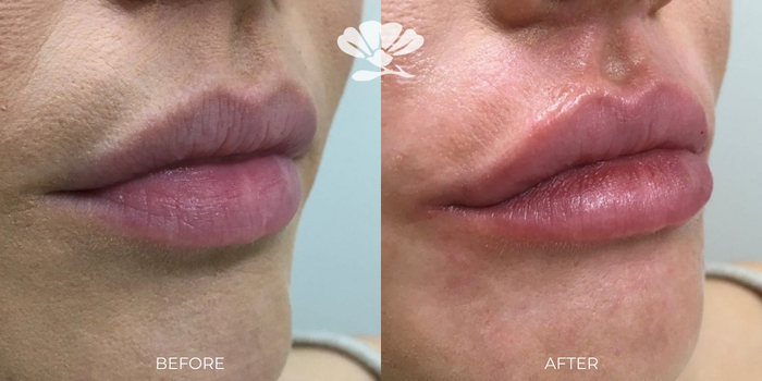 Perth lip filler before and after