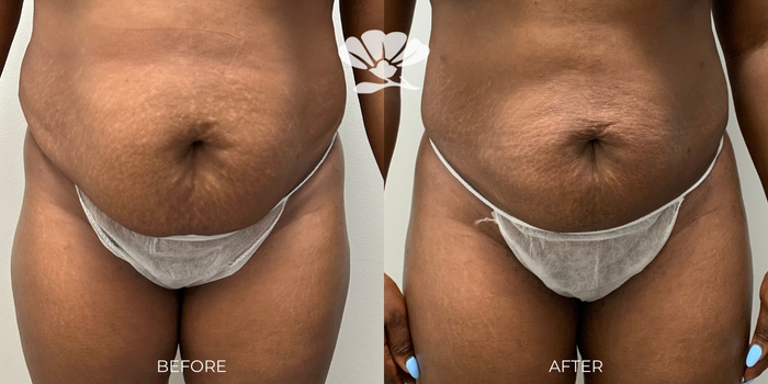 Liposuction Fat Transfer belly fat reduction Perth