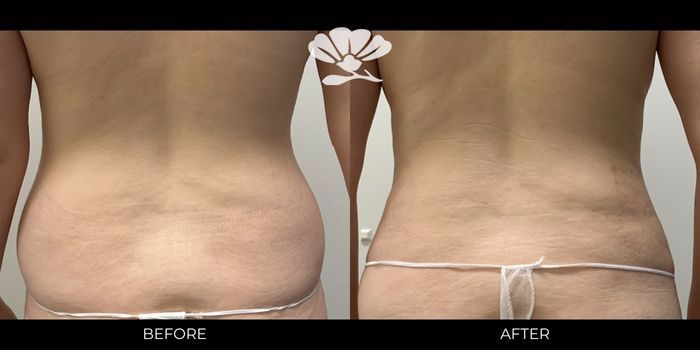 Perth abdominal Liposuction fat reduction