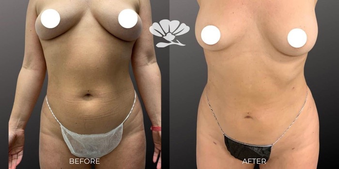 Vaser Liposuction, Renuvion skin tightening surgical and Fat Transfer Perth