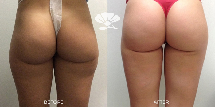 Thigh and Buttock Liposuction Fat transfer hip dips BBL Perth