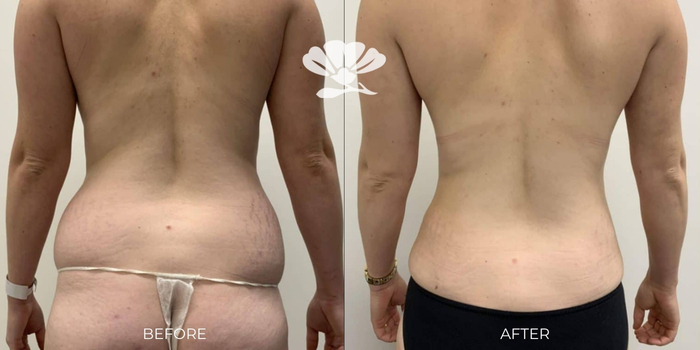 Liposuction to love handles Perth