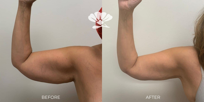 Arm fat liposuction Perth - Before and After