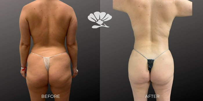 Liposuction Perth