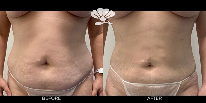 Liposuction stomach belly tummy fat removal abdomen Perth