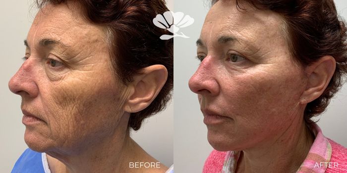 Perth Mini Face Lift Surgery Neck Lift Best Near Me