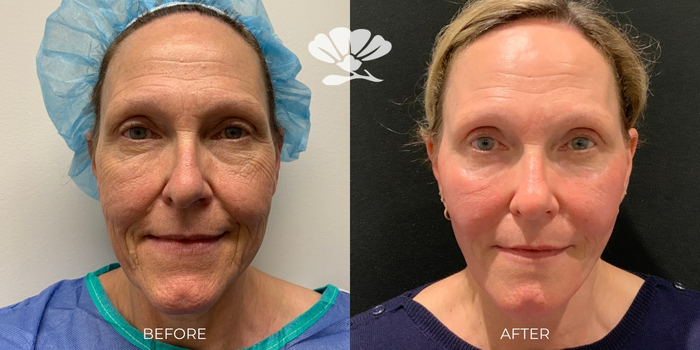 Mini Face Lift Perth Surgery